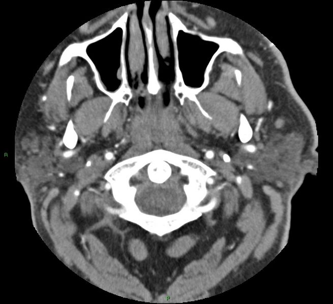 File:Brainstem hemorrhage (Radiopaedia 58794-66028 D 5).jpg
