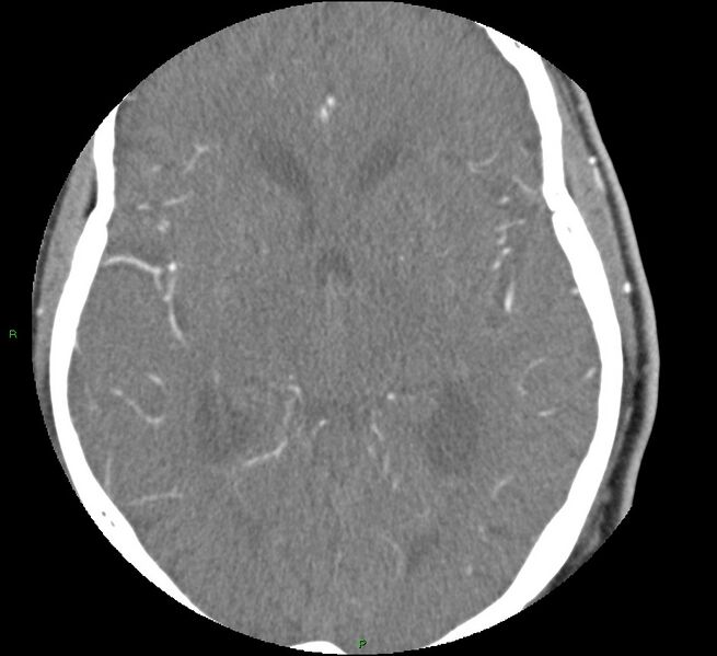 File:Brainstem hemorrhage (Radiopaedia 58794-66028 D 94).jpg