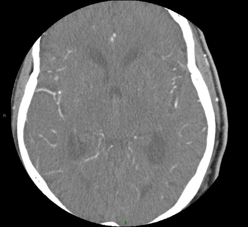 Brainstem hemorrhage (Radiopaedia 58794-66028 D 94).jpg