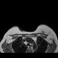 Breast implants - MRI (Radiopaedia 26864-27035 Axial T1 44).jpg