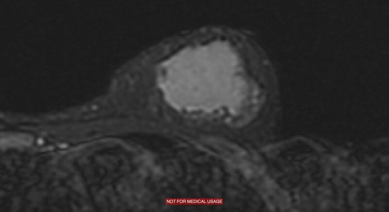 File:Breast lymphoma (MRI) (Radiopaedia 34999-36498 Axial STIR 7).jpg