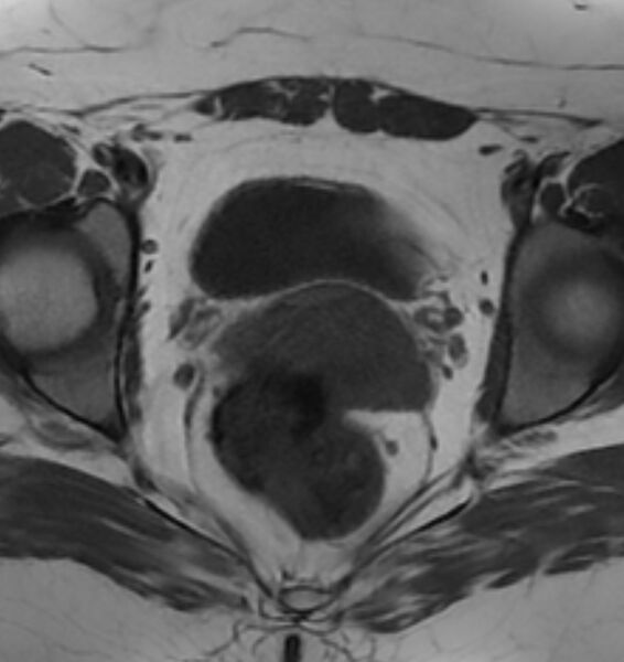 File:Broad ligament leiomyoma (Radiopaedia 81634-95516 Axial T1 17).jpg