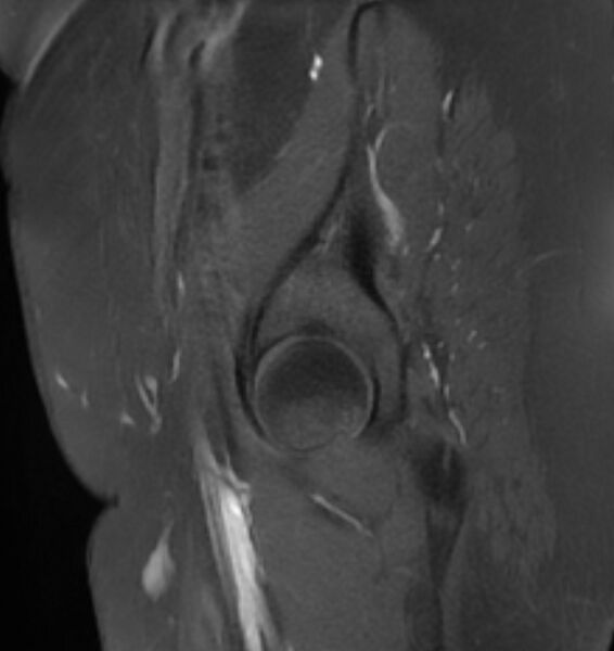 File:Broad ligament leiomyoma (Radiopaedia 81634-95516 G 1).jpg