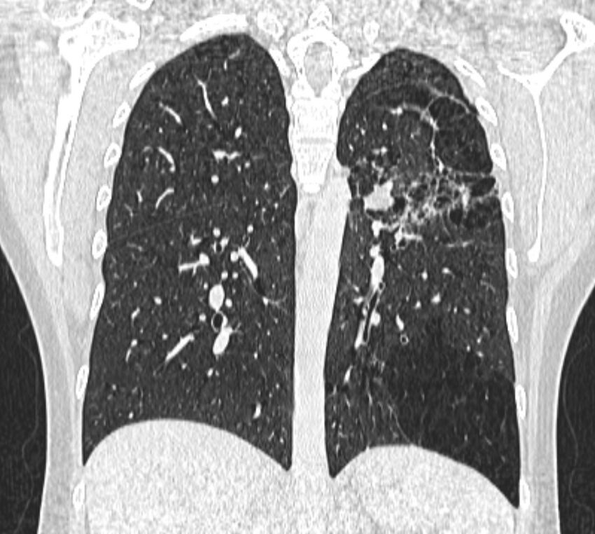 Bronchial atresia (Radiopaedia 50007-55297 Coronal lung window 74).jpg