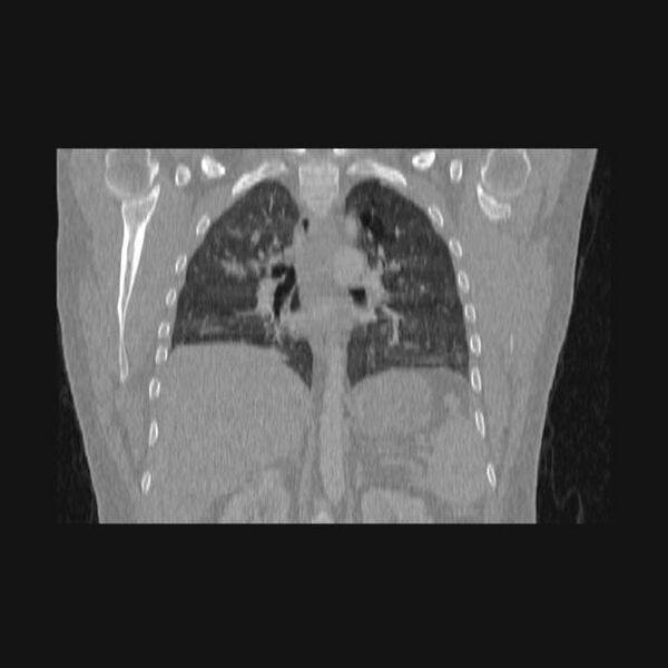 File:Bronchial atresia (Radiopaedia 60685-68439 Coronal lung window 30).jpg