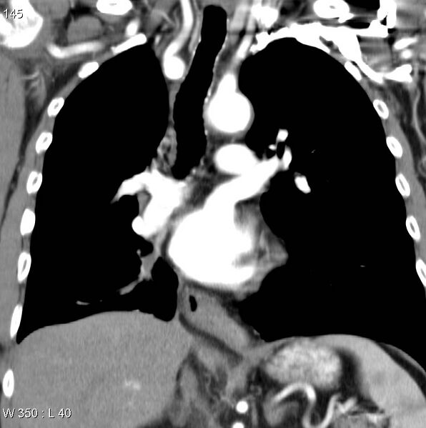 File:Bronchial carcinoid tumor with right lower lobe collapse (Radiopaedia 29060-29422 C 14).jpg