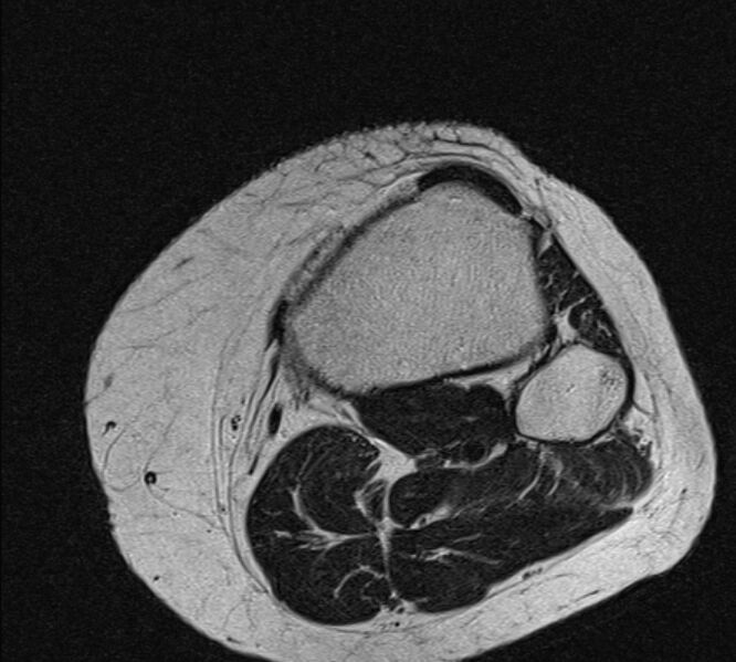 File:Bucket handle tear - medial meniscus (Radiopaedia 79028-91942 Axial T2 1).jpg