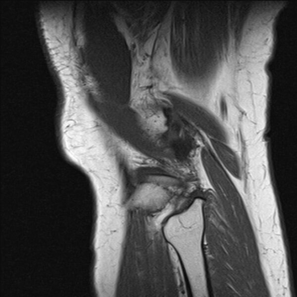 File:Bucket handle tear - medial meniscus (Radiopaedia 79028-91942 Sagittal T1 2).jpg