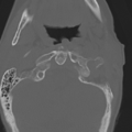 C2 fracture with vertebral artery dissection (Radiopaedia 37378-39199 Axial bone window 11).png