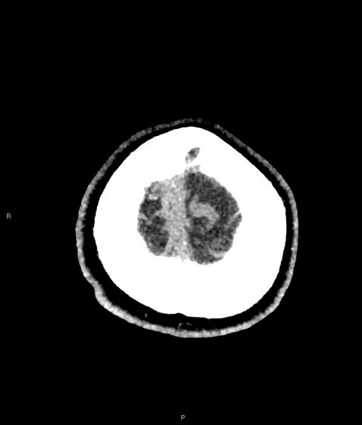 File:Calcified cerebral emboli from left ventricular thrombus (Radiopaedia 84420-99758 Axial non-contrast 8).jpg