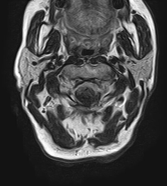 File:Calcified meningioma - cervical canal (Radiopaedia 70136-82468 Axial T2 6).jpg