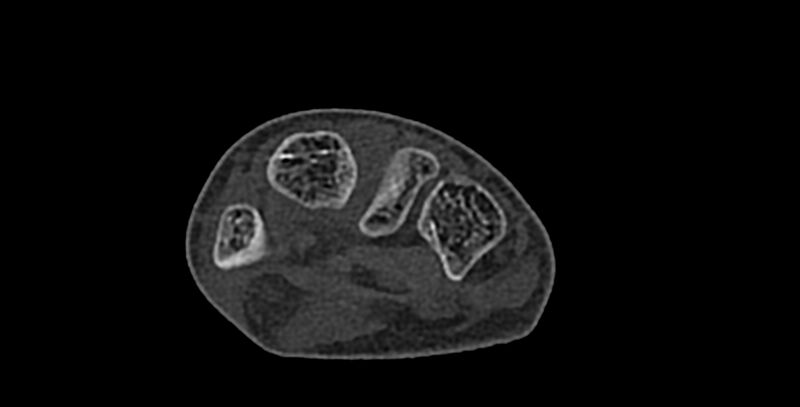 File:Calcifying aponeurotic fibroma (Radiopaedia 88423-105064 Axial bone window 111).jpg