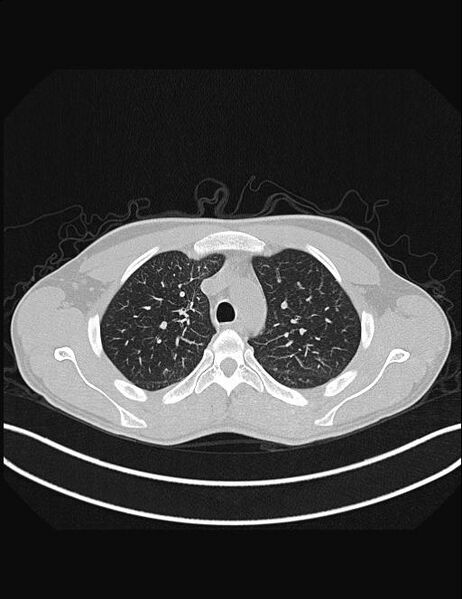 File:Calcifying pulmonary metastases (Radiopaedia 33359-34396 Axial lung window 17).jpg