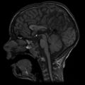 Callosal dysgenesis and ectopic posterior pituitary (Radiopaedia 8382-9213 Sagittal T1 1).jpg