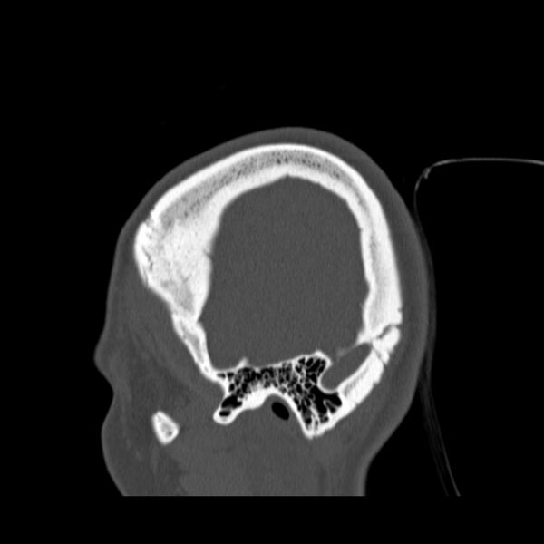 File:Calvarial osteoma (Radiopaedia 36520-38079 Sagittal bone window 16).jpg