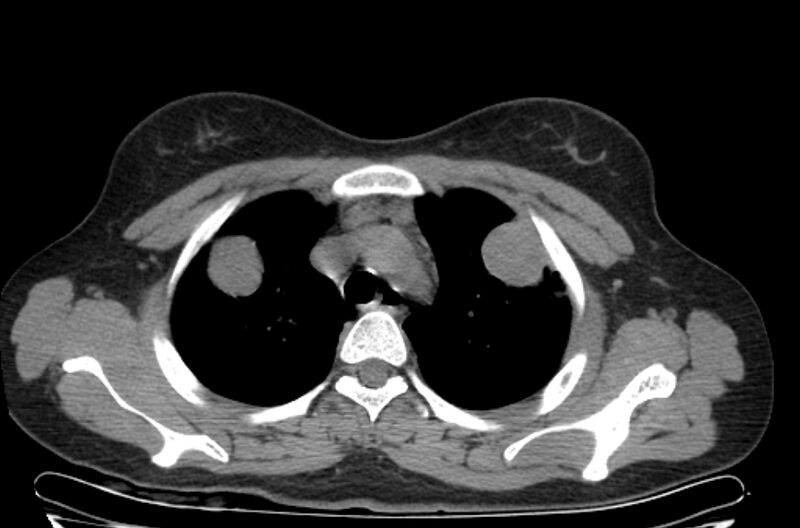 File:Cannonball metastases - uterine choriocarcinoma (Radiopaedia 70137-80173 Axial non-contrast 20).jpg