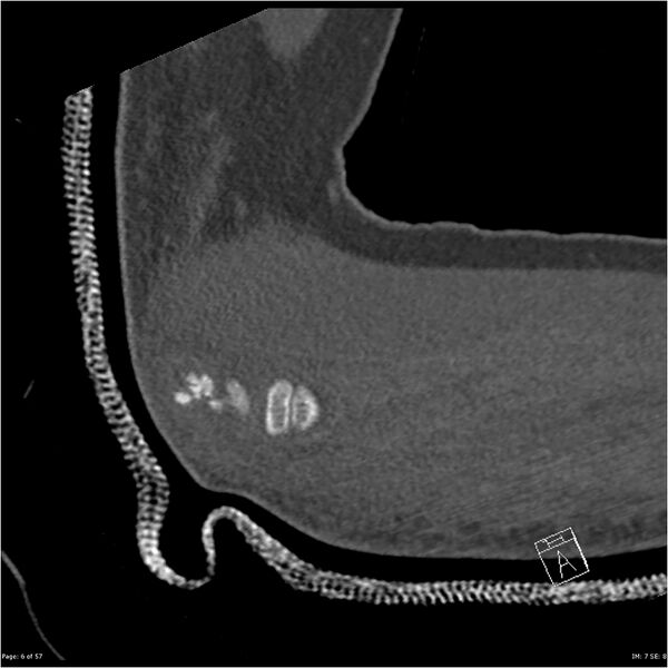 File:Capitellum fracture (Radiopaedia 23352-23426 Sagittal bone window 6).jpg