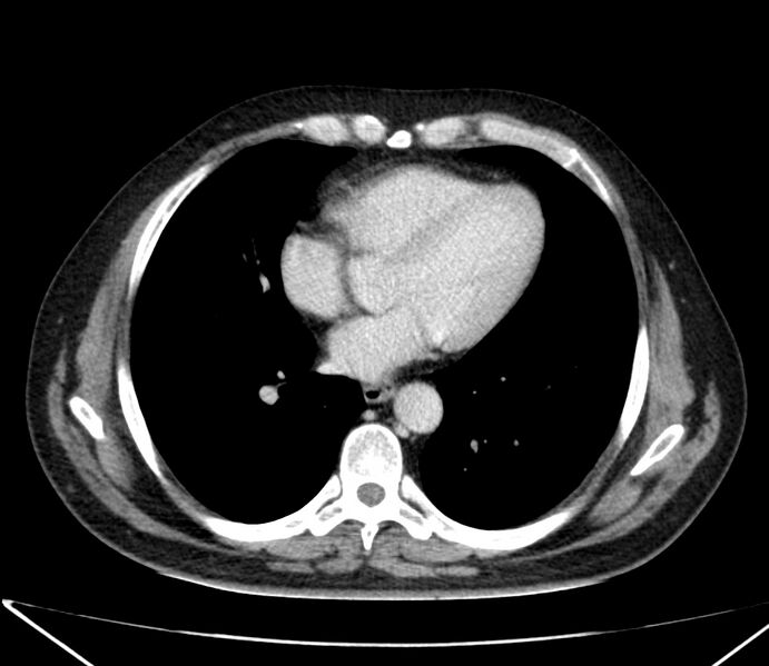 File:Carcinoid tumor with hepatic metastases (Radiopaedia 22651-22670 C 22).jpg