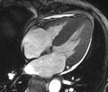 Cardiac amyloidosis (Radiopaedia 39736-42124 D 12).jpg
