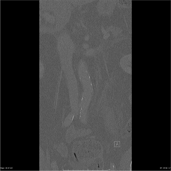 File:Cardiac trauma (Radiopaedia 32874-33858 Coronal bone window 18).jpg