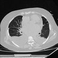 Cardiogenic pulmonary edema (Radiopaedia 29213-29609 Axial lung window 55).jpg