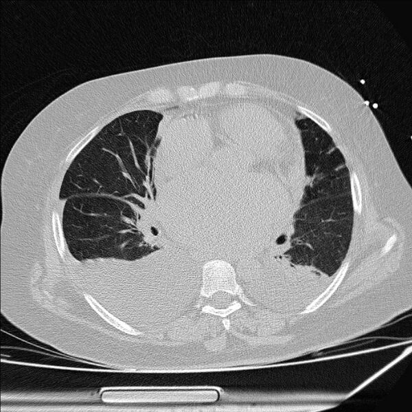 File:Cardiogenic pulmonary edema (Radiopaedia 29213-29609 Axial lung window 55).jpg