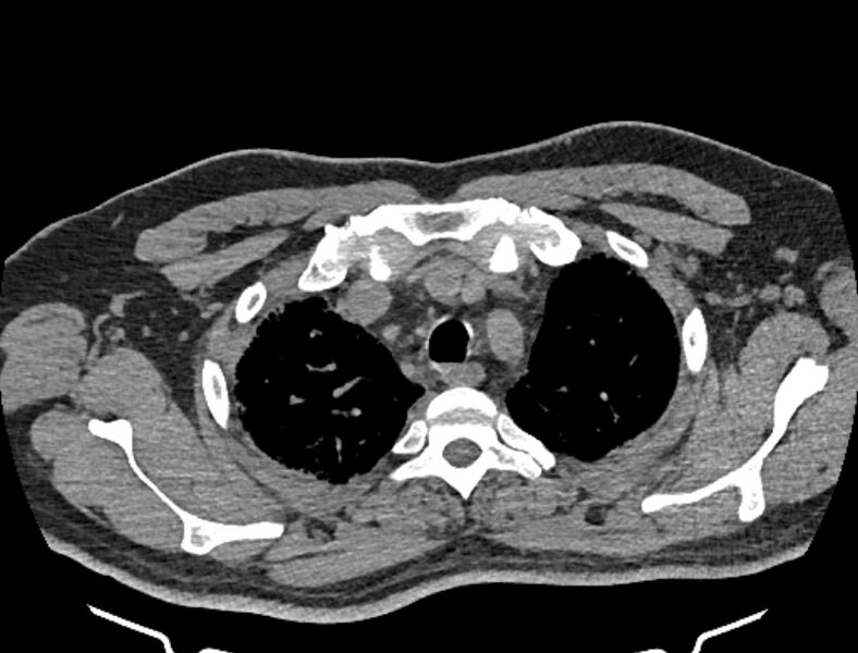 File:Cardiogenic pulmonary edema (Radiopaedia 68180-77678 Axial non-contrast 7).jpg