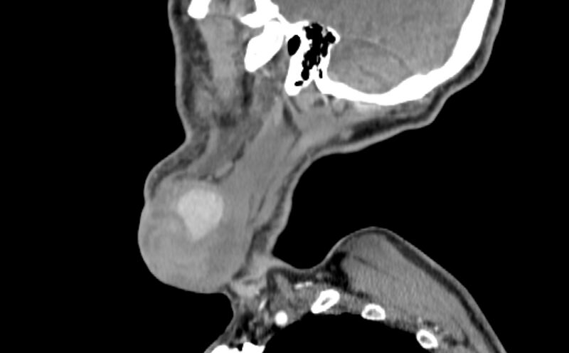 File:Carotid artery pseudoaneurysm (Radiopaedia 84030-99259 E 54).jpg