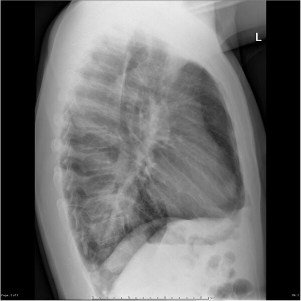File:Cavitating lung cancer (Radiopaedia 25796-25944 Lateral 1).jpg