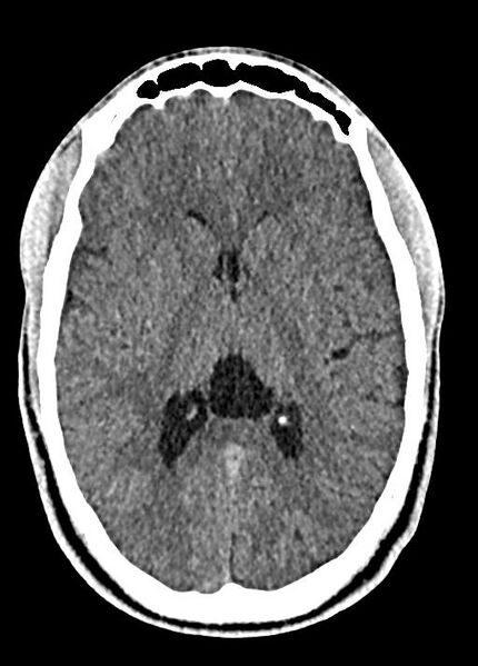 File:Cavum septum pellucidum and cavum vergae (Radiopaedia 77797-90060 Axial Brain Window 54).jpg