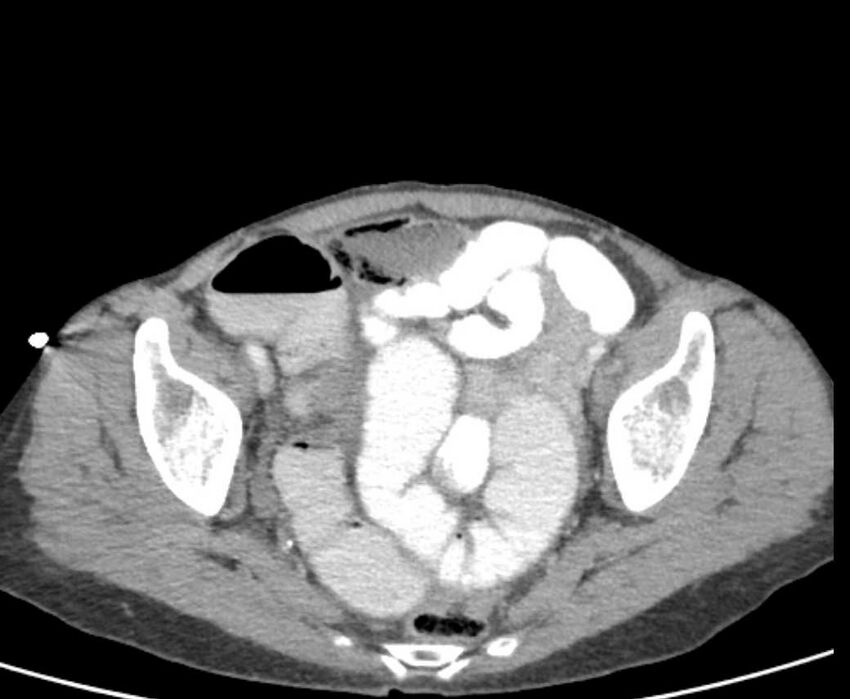Cecal volvulus with pneumatosis coli (Radiopaedia 68572-78178 A 106).jpg