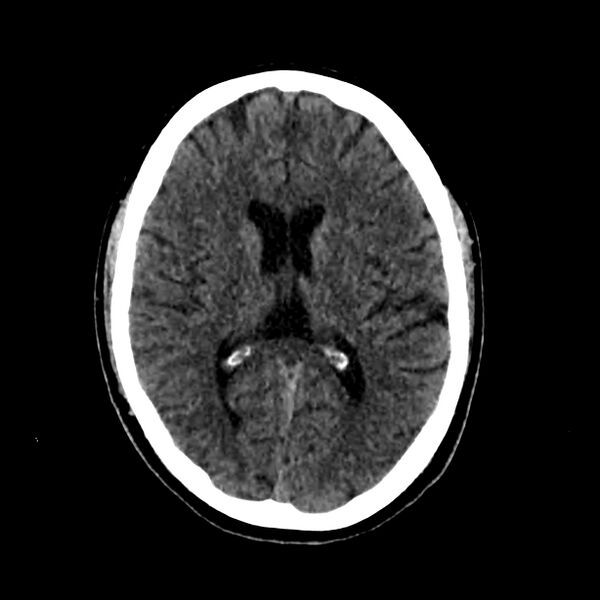 File:Central nervous system Langerhans cell histiocytosis (Radiopaedia 65728-74878 Axial non-contrast 30).jpg