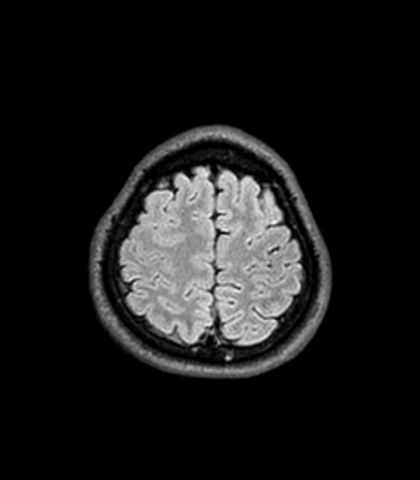 Central neurocytoma (Radiopaedia 79320-92380 Axial FLAIR 65).jpg
