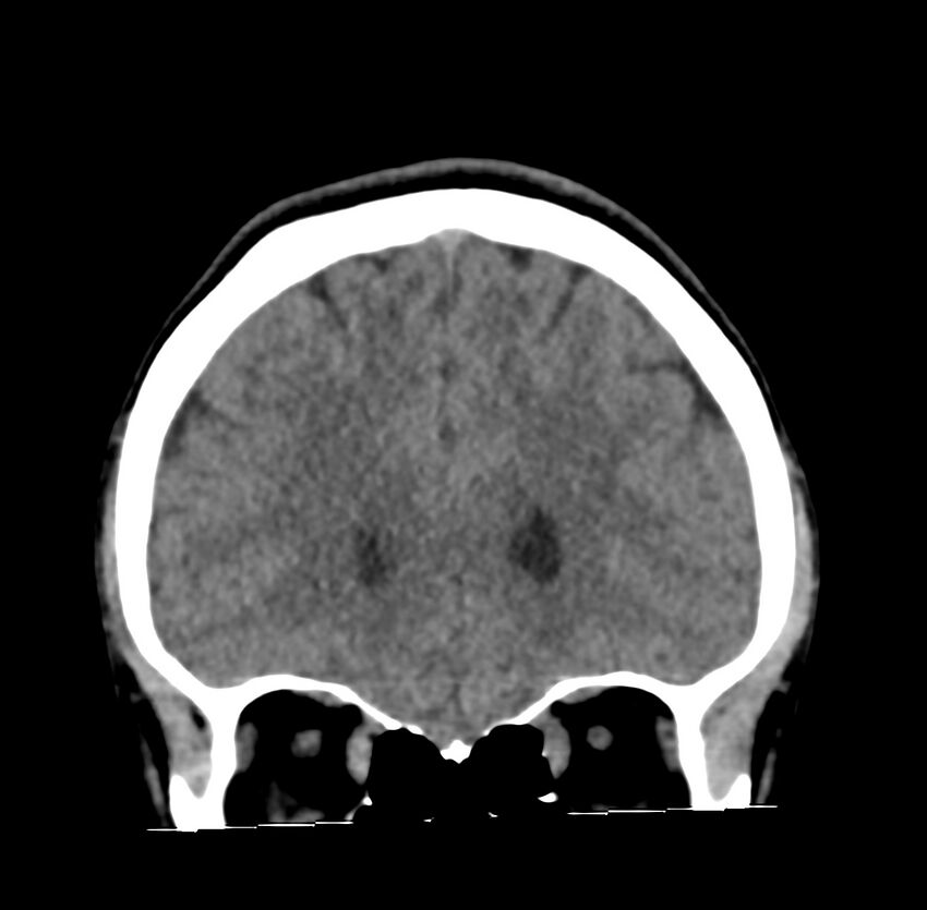 Cerebellar agenesis (Radiopaedia 30203-30817 Coronal non-contrast 3).jpg