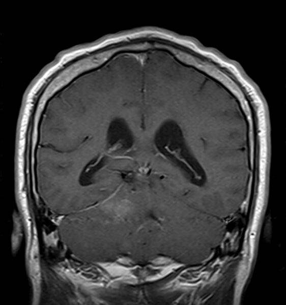 File:Cerebellopontine angle meningioma (Radiopaedia 24459-24764 Coronal T1 C+ 16).jpg