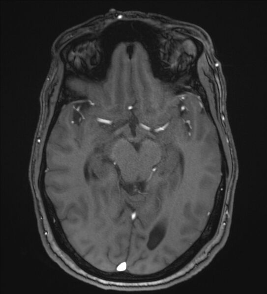 File:Cerebellopontine angle meningioma (Radiopaedia 72983-83680 Axial MRA 53).jpg