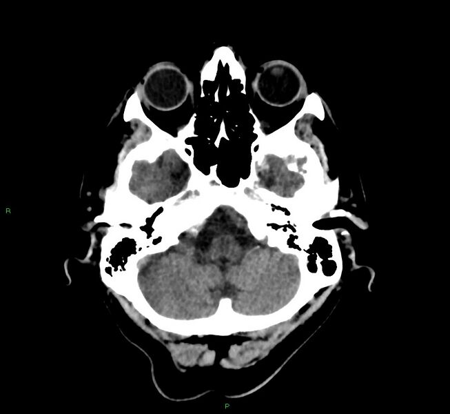 File:Cerebral amyloid angiopathy-associated lobar intracerebral hemorrhage (Radiopaedia 58376-65513 Axial non-contrast 42).jpg