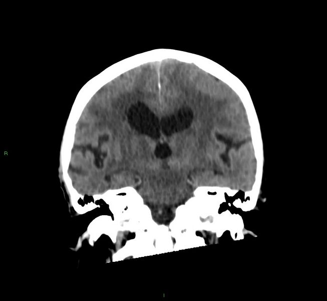 File:Cerebral amyloid angiopathy-associated lobar intracerebral hemorrhage (Radiopaedia 58530-65688 Coronal non-contrast 34).jpg