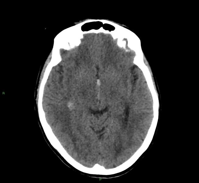 File:Cerebral amyloid angiopathy-associated lobar intracerebral hemorrhage (Radiopaedia 58566-65730 Axial non-contrast 30).jpg