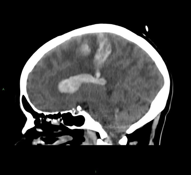 File:Cerebral amyloid angiopathy-associated lobar intracerebral hemorrhage (Radiopaedia 58566-65730 C 23).jpg