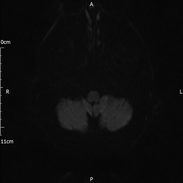 File:Cerebral amyloid angiopathy related inflammation (Radiopaedia 72772-83415 Axial DWI 50).jpg