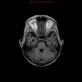 Cerebral and orbital tuberculomas (Radiopaedia 13308-13311 Axial T1 C+ 7).jpg