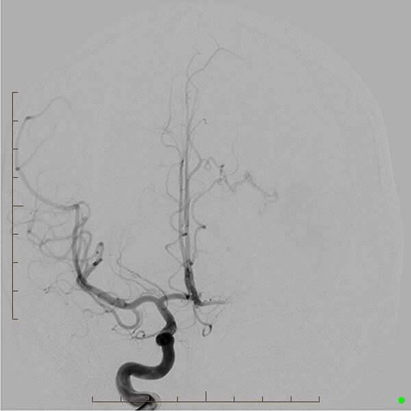 File:Cerebral arteriovenous malformation (AVM) (Radiopaedia 78162-90707 A 7).jpg