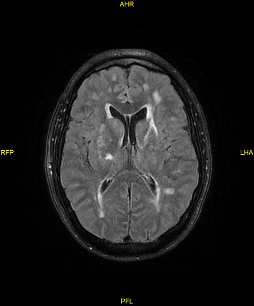 File:Cerebral autosomal dominant arteriopathy with subcortical infarcts and leukoencephalopathy (CADASIL) (Radiopaedia 86108-102054 Axial FLAIR 17).jpg