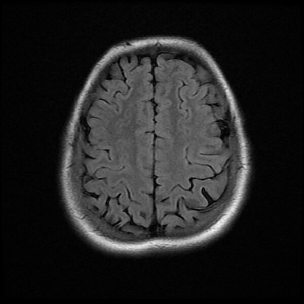 File:Cerebral cavernous malformation (Radiopaedia 44301-47942 Axial FLAIR 17).jpg
