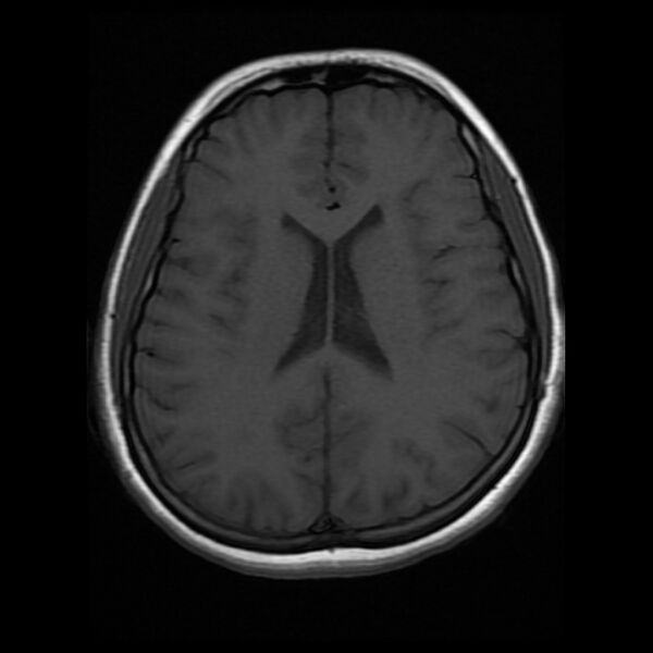 File:Cerebral cavernous malformation (Radiopaedia 44301-47942 Axial T1 13).jpg