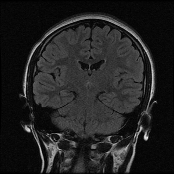 File:Cerebral cavernous malformation (Radiopaedia 44301-47942 Coronal FLAIR 13).jpg