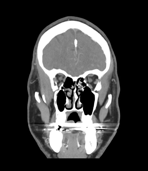 File:Cerebral dural venous sinus thrombosis (Radiopaedia 86514-102576 B 10).jpg