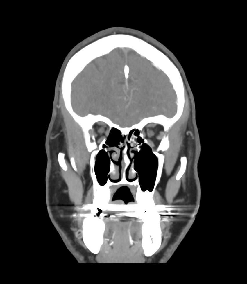 Cerebral dural venous sinus thrombosis (Radiopaedia 86514-102576 B 10).jpg