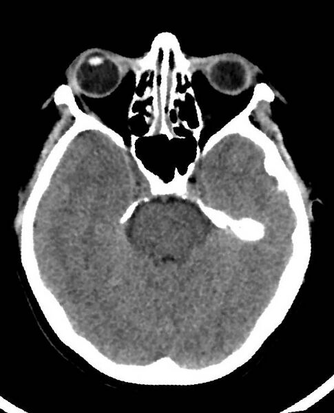 File:Cerebral edema due to severe hyponatremia (Radiopaedia 89826-106938 Axial non-contrast 35).jpg